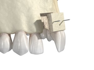 bone grafting placement image